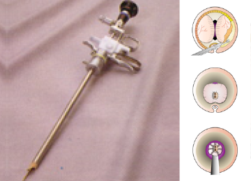 平岡式内視鏡手術